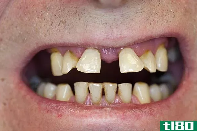 牙龈炎(gingivitis)和牙周炎(periodontitis)的区别