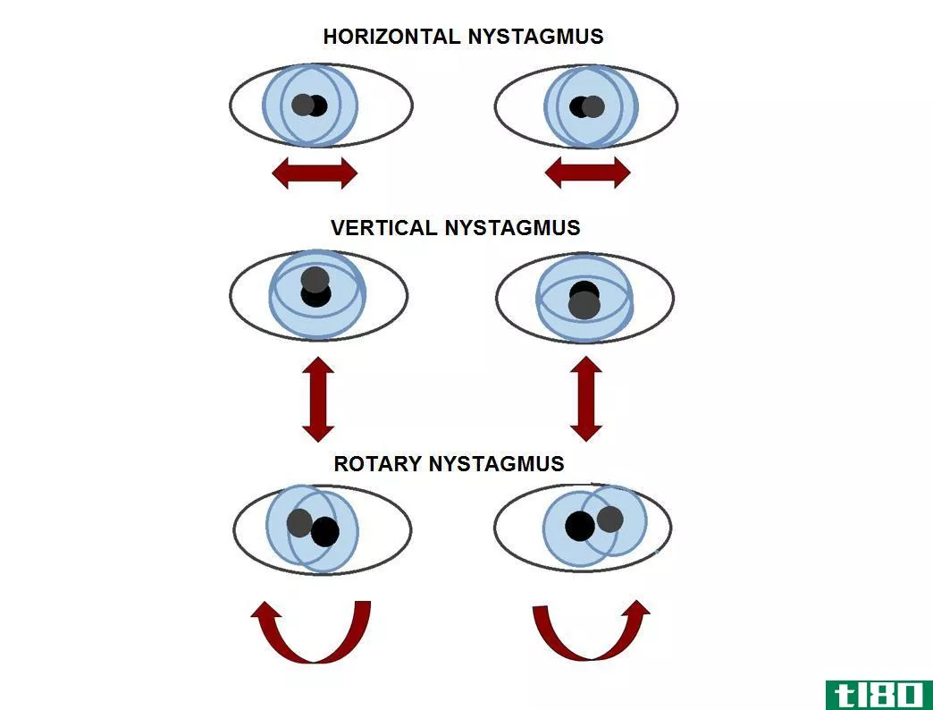 水平眼震(horizontal nystagmus)和垂直性眼球震颤(vertical nystagmus)的区别