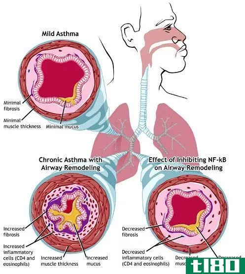 严重的(acute)和慢性哮喘恶化(chronic asthma exacerbation)的区别