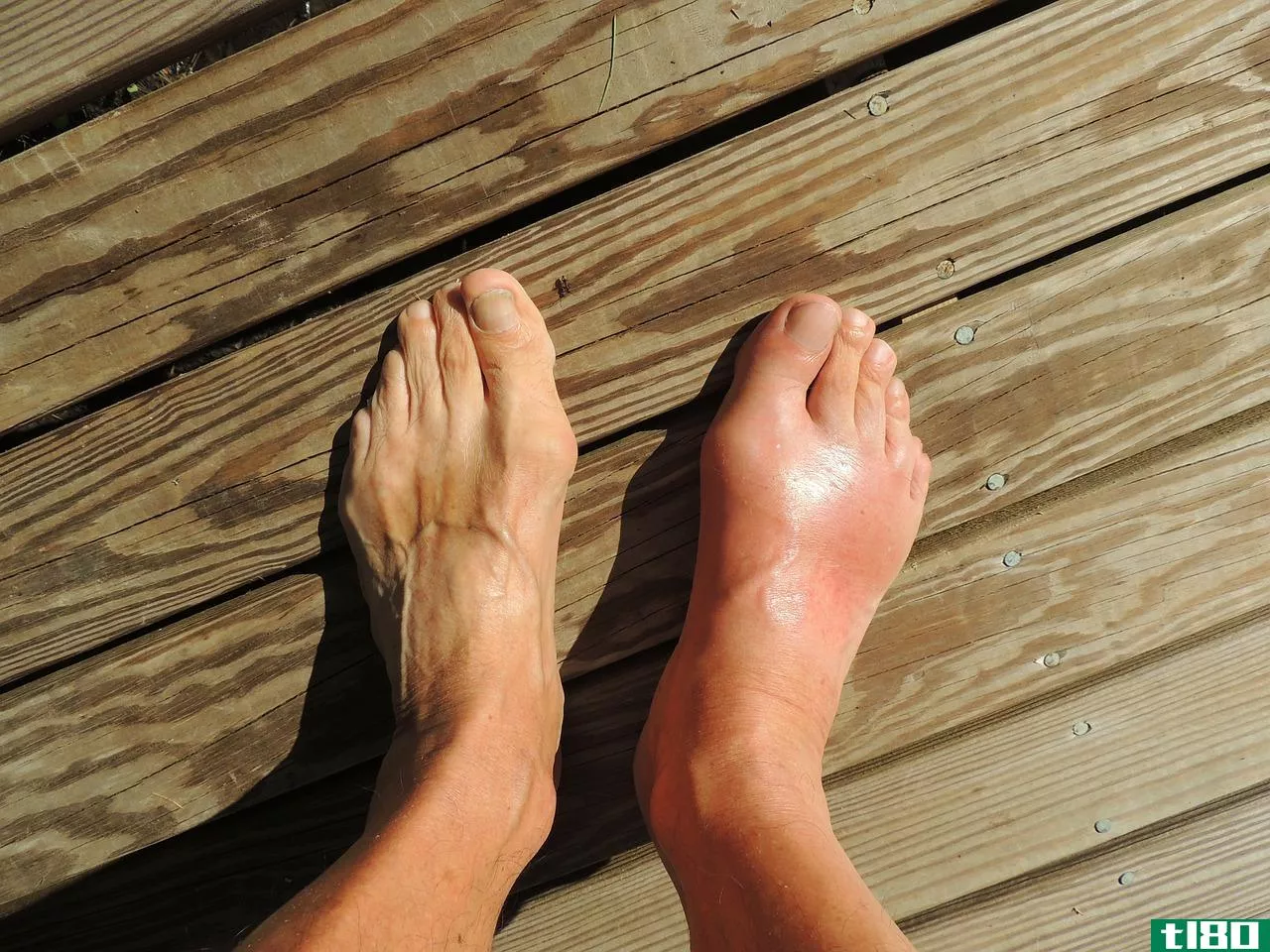痛风(gout)和类风湿性关节炎(rheumatoid arthritis)的区别